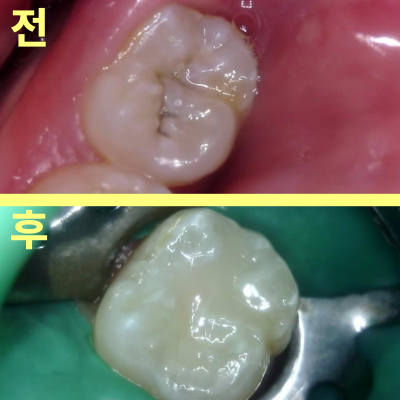 등촌역치과 아무런 증상 없었는데 충치가 7개나 발견된 이유