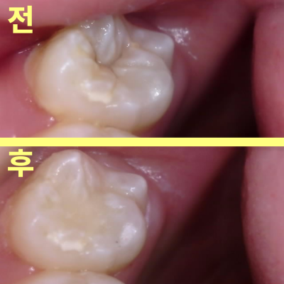 등촌역치과 아무런 증상 없었는데 충치가 7개나 발견된 이유