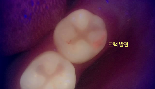 입안 치아의 클로즈업 사진으로, 특수 조명 아래 치아에 붉은색으로 크랙이 표시되어 있다.
