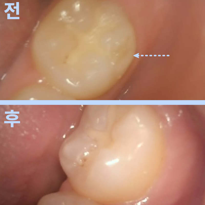 치아에 금이 갔다면, 무조건 크라운을 해야 할까요?