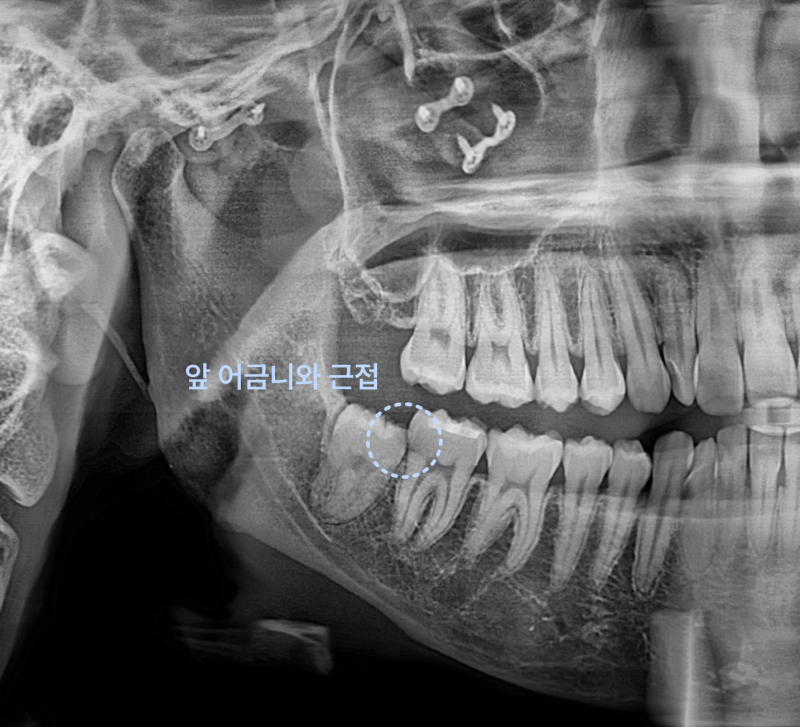 앞 어금니와 근접한 사랑니 엑스레이