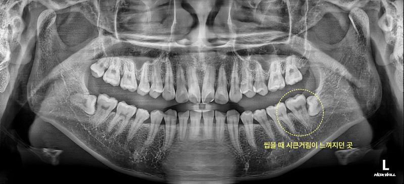 치아 엑스레이 사진에 오른쪽 아래 어금니 부위에 노란색 점선 원이 표시되어 있다.