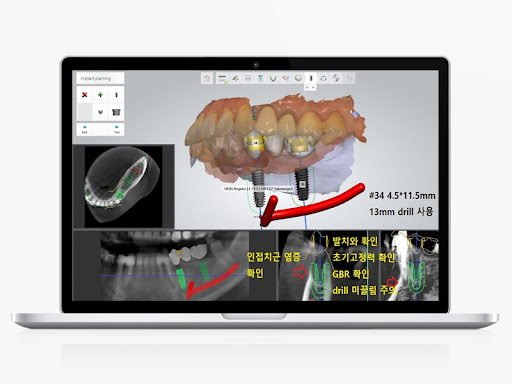노트북 화면에 임플란트 시술 계획을 보여주는 3D 치아 모델링이 띄워져 있다.