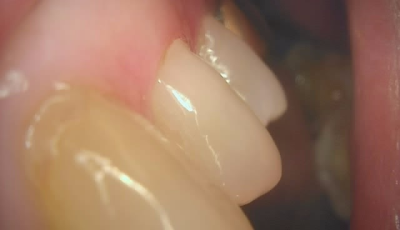 매년 스케일링해도 충치와 잇몸 염증이 생기는 이유