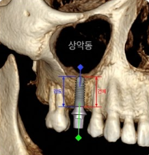 3D 엑스레이 사진에 상악동과 임플란트의 길이가 표시되어 있다.