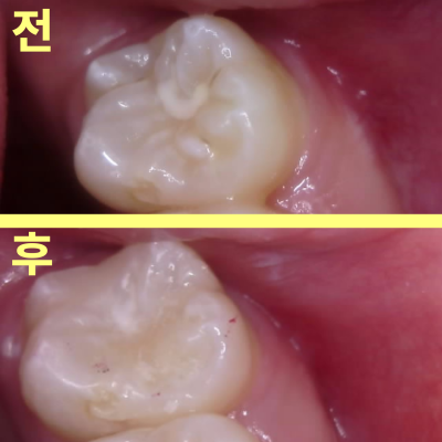 등촌역치과 아무런 증상 없었는데 충치가 7개나 발견된 이유