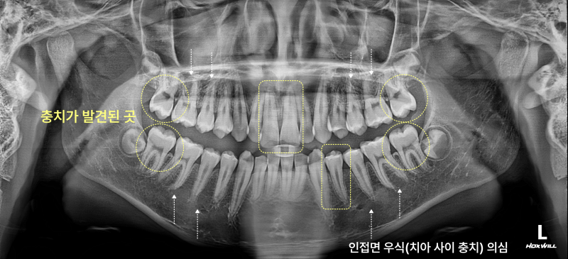 파노라마 엑스레이 사진에 충치가 발견된 부위가 표시되어 있다.