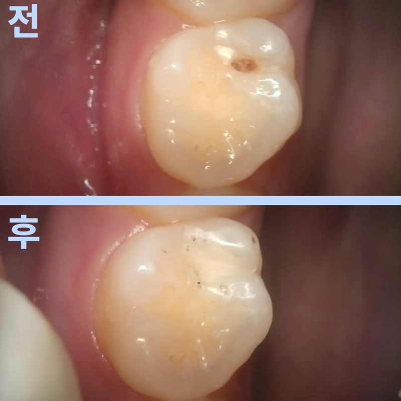 치아에 금이 갔다면, 무조건 크라운을 해야 할까요?