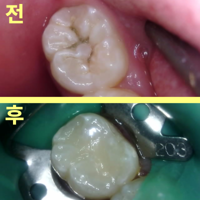 등촌역치과 아무런 증상 없었는데 충치가 7개나 발견된 이유