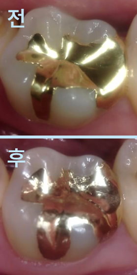 금 인레이 재제작 전후 비교 사진