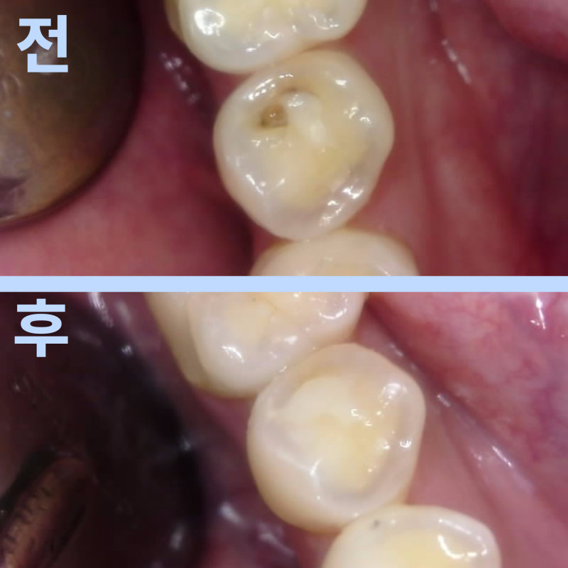 교합면 충치 치료 전후 비교 사진