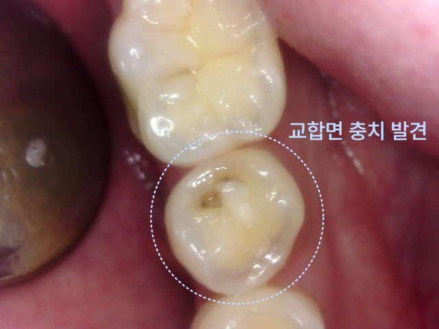 교합면에 충치가 발견된 어금니의 근접 촬영 사진