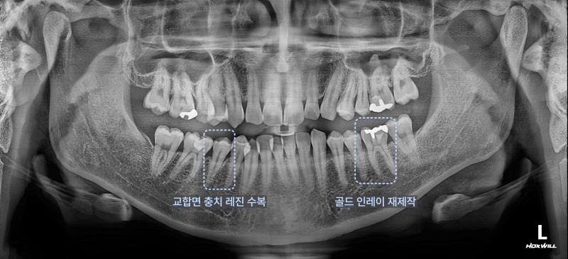 교합면 충치 레진 수복 및 골드 인레이 재제작 부위를 표시한 파노라마 엑스레이