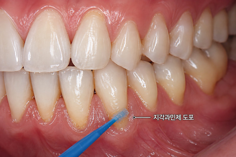 치경부 마모가 있는 치아에 지각과민제 도포 치료를 하는 모습