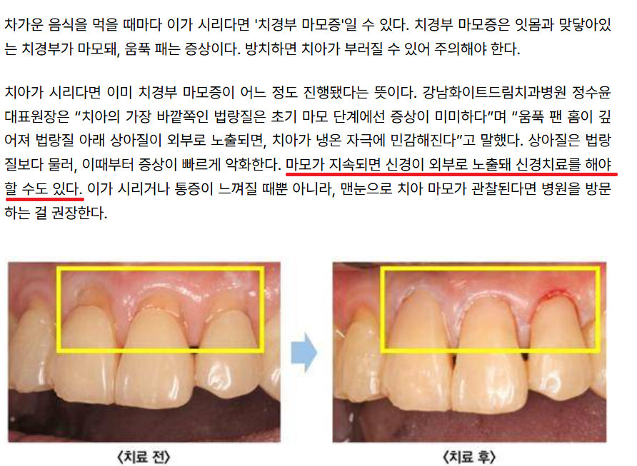 마곡치과 찬물 마실 때 시린 이, 충치 때문만은 아닙니다