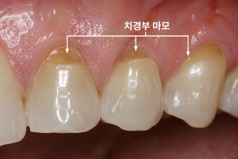 잇몸 경계 부위 치아에 치경부 마모가 발생하여 움푹 패인 모습
