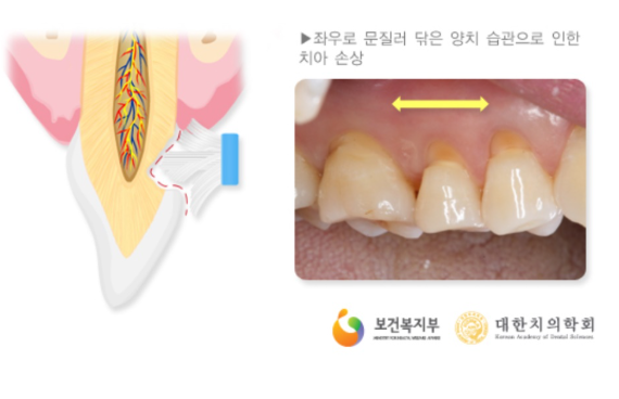 좌우로 문지르는 칫솔질로 인한 치아 손상을 보여주는 일러스트와 실제 치아 사진