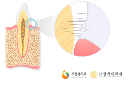 잘못된 칫솔질로 인해 치아 표면이 마모되는 과정을 보여주는 일러스트