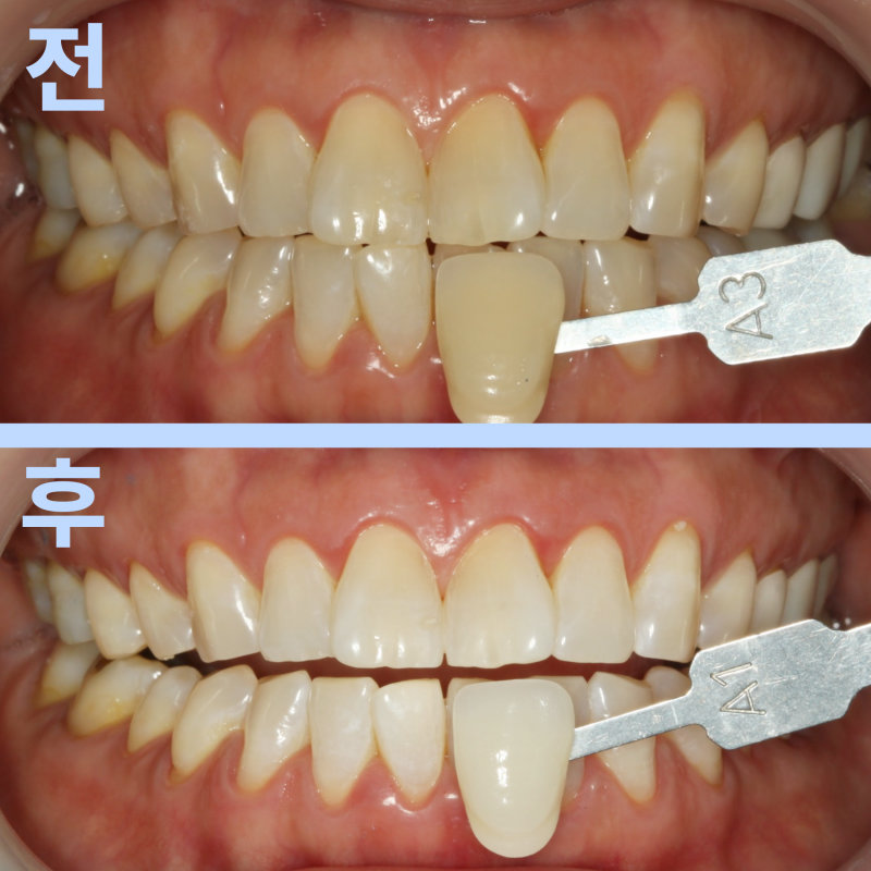치아 미백 전(상단)과 후(하단)의 치아 색상을 비교한 구강 내 사진