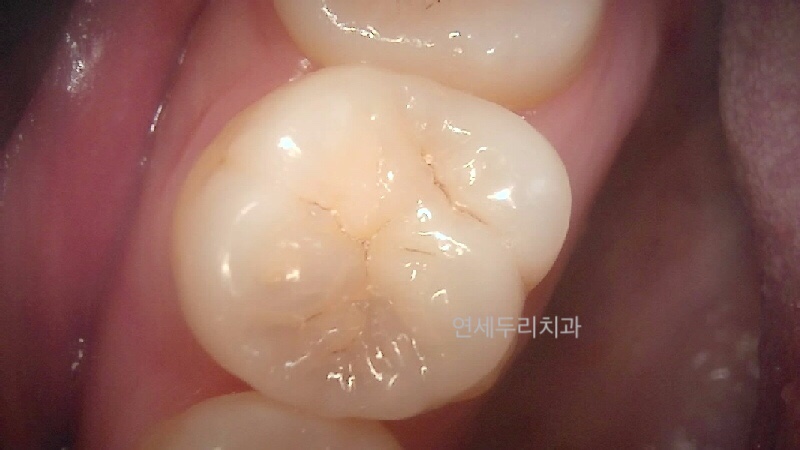 어금니 교합면에 미세한 균열이 보이는 치아의 근접 촬영 사진