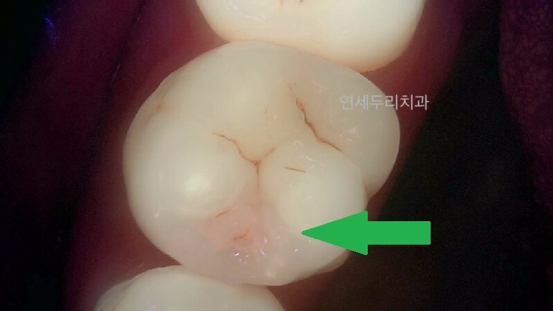 어금니 인접면에 붉은 빛이 보이는 치아의 근접 촬영 사진