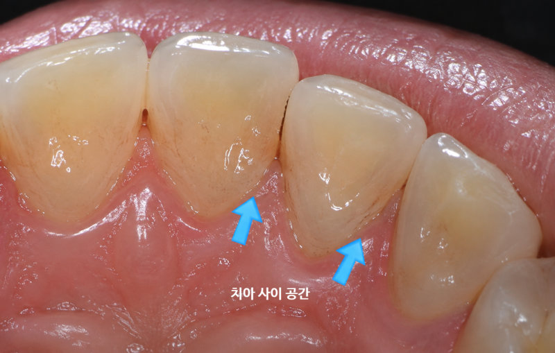 치아 사이 공간에 음식물이 끼어 있는 앞니의 근접 촬영 사진