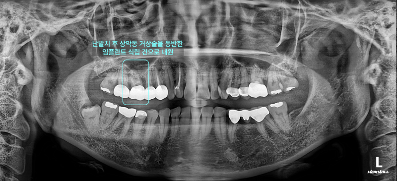 난발치 후 상악동 거상술을 동반한 임플란트 식립 건으로 내원한 환자의 파노라마 방사선 사진