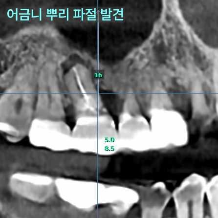 어금니 뿌리 파절이 발견된 상악 어금니 부위의 치과 CT 사진