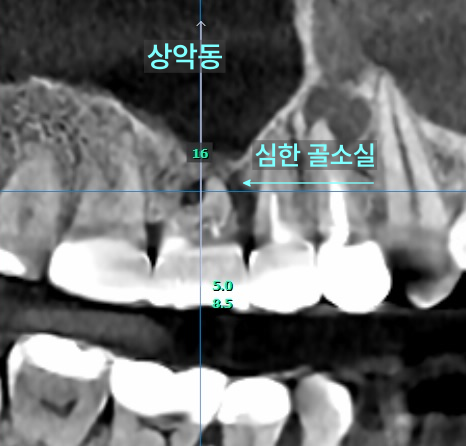 상악동 부위에 심한 골소실이 관찰되는 치과 CT 사진
