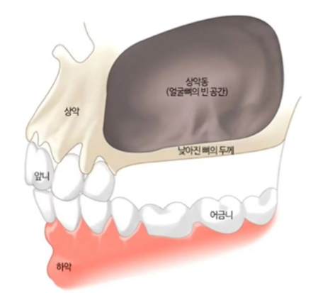 상악동과 뼈의 두께, 앞니, 어금니, 하악을 보여주는 치아 해부학 모식도