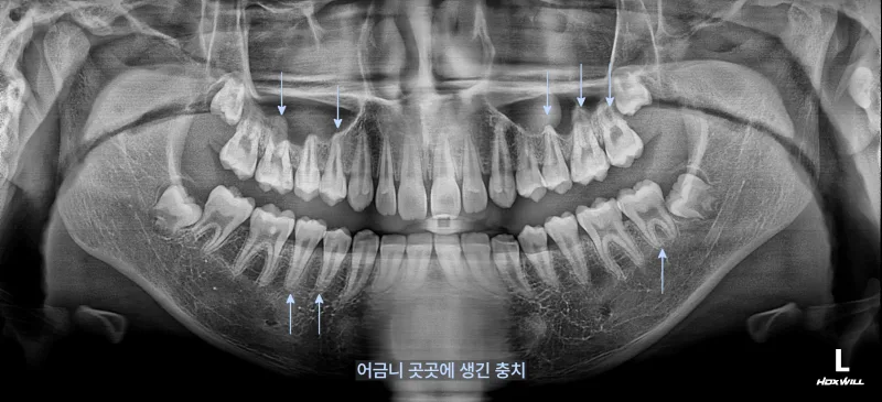 파노라마 엑스레이 사진. 위아래 치아 전체가 보이며, 여러 치아에 화살표로 충치 위치를 표시했다.