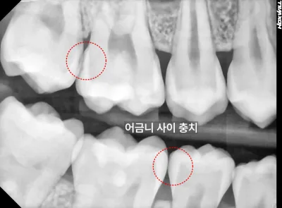 치아 엑스레이 사진. 어금니 사이 충치 부위를 빨간 점선 원으로 표시했다.