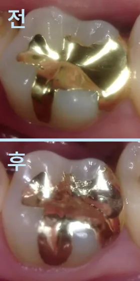 가양역치과 금니 아래 충치를 찾는 기준
