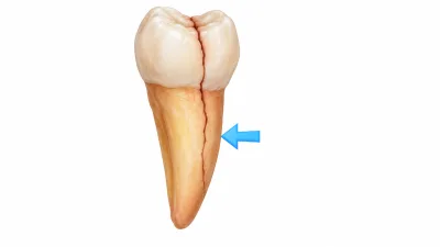 세로로 금이 간 치아의 3D 애니메이션 이미지. 화살표가 금이 간 부위를 가리킨다.