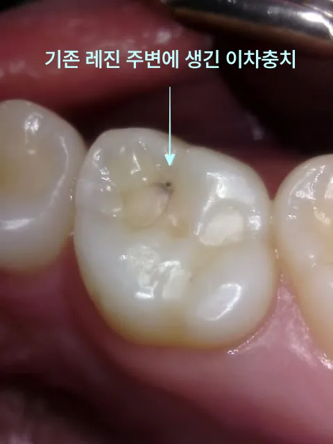 기존 레진 수복물 주변에 이차 충치가 발생한 어금니의 구강 내 사진.