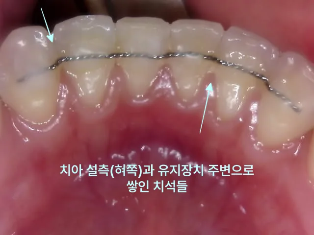 치아 설측에 부착된 유지장치 주변에 치석이 쌓여있는 모습의 구강 내 사진.