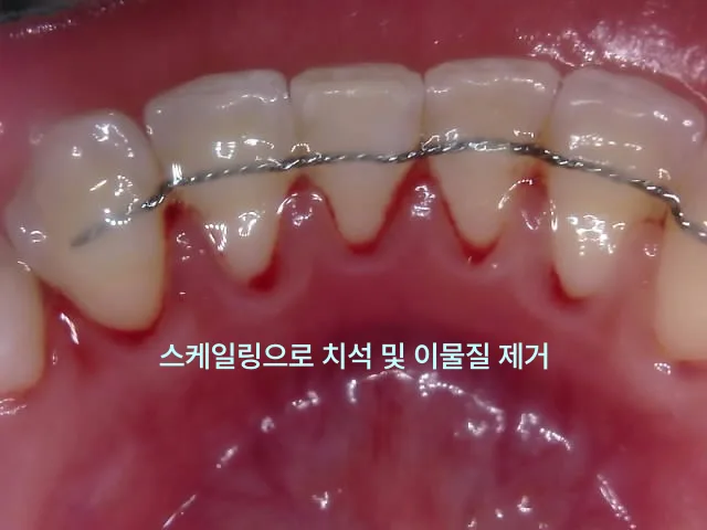 스케일링 후 치아 설측 유지장치 주변의 치석과 이물질이 제거된 모습의 구강 내 사진.