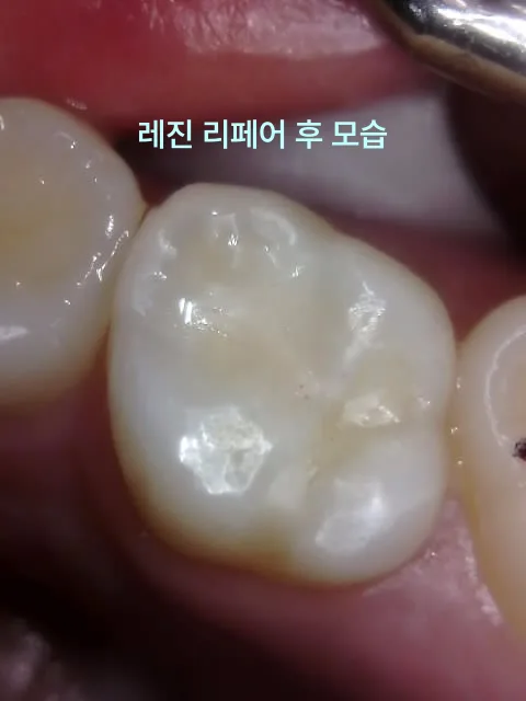 레진 수복 치료가 완료된 어금니의 구강 내 사진.