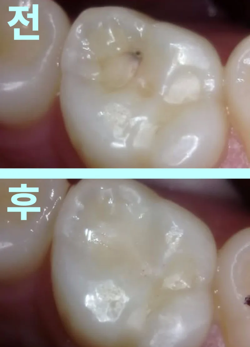레진 수복 치료 전과 후의 어금니 모습을 비교하는 두 컷의 구강 내 사진.