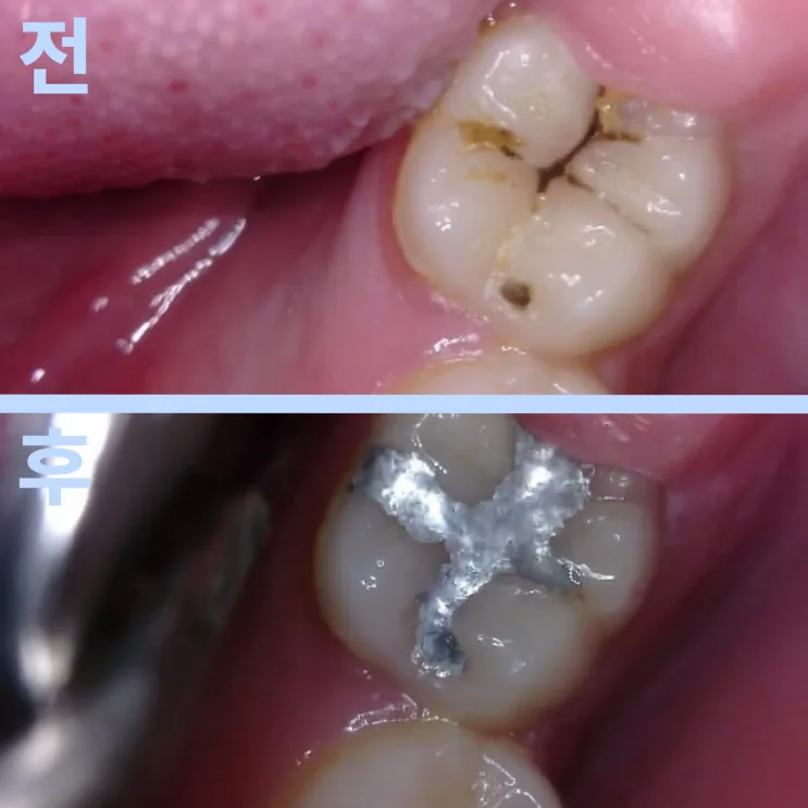 우장산역치과 충치 7개, 왜 1개만 치료했을까?