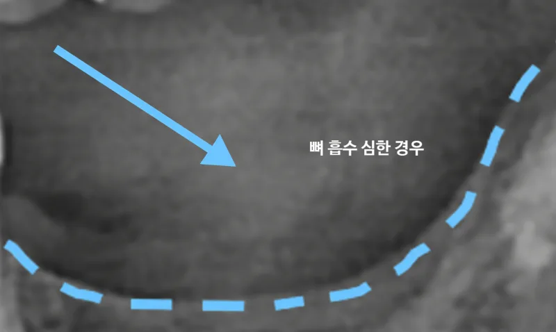 뼈 흡수가 심한 경우를 나타내는 치과 방사선 이미지
