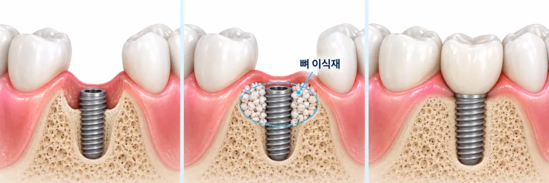 임플란트 식립 시 뼈이식 과정을 보여주는 3단계 치과 시뮬레이션 이미지