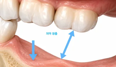 치아가 없는 부위의 치조골 위축과 대합치의 정출을 보여주는 치과 시뮬레이션