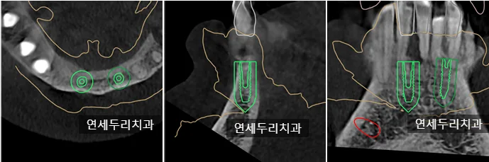하악 어금니 부위 임플란트 식립 계획을 보여주는 CT 방사선 사진